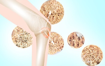 Animated image of leg bones with osteoporosis