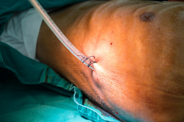 image of patient with a sutured in chest tube