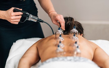 healthcare practitioner applying multiple cups to a patient's back.