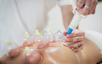 Practitioner performing vacuum cupping on a patient's back