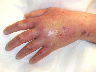 Picture of an infiltrated hand