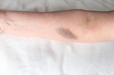 Hematoma from IV placement.